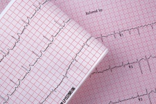 Cardiogramma Elettrocardiogramma