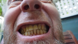 黄色の歯