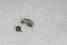 Pieces Of A Silver Tooth Filling