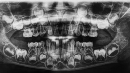 X-ray Of Growing Teeth