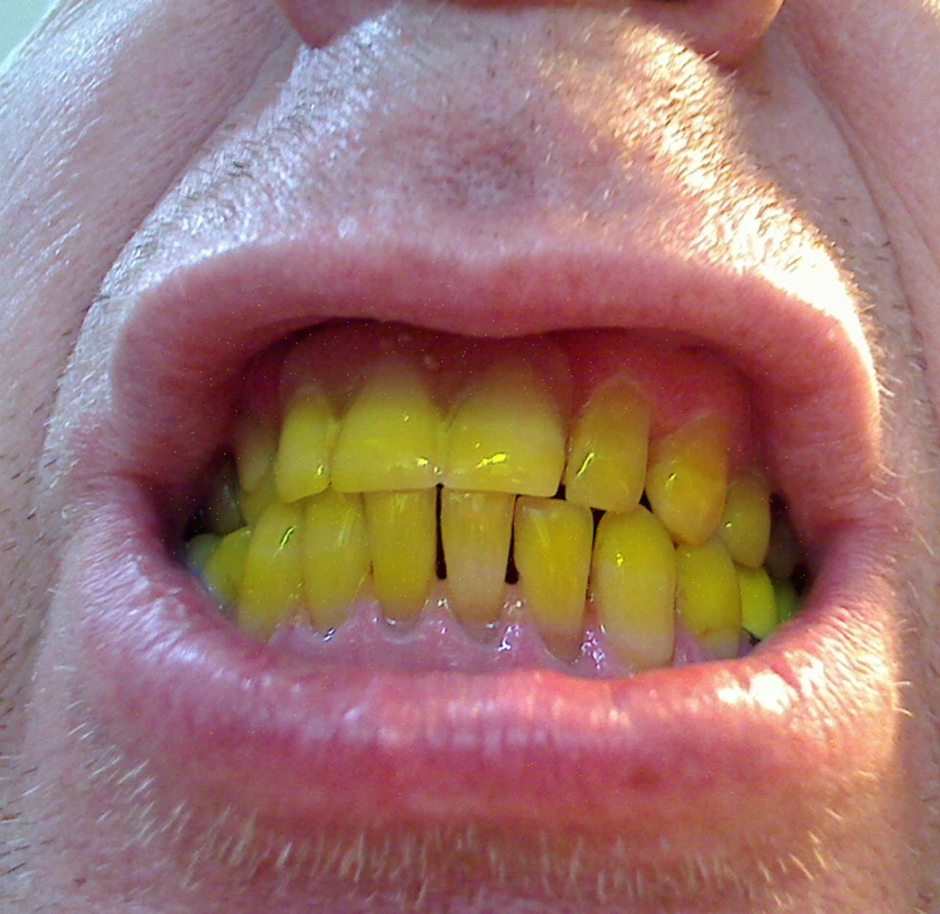 Мои желтые зубы